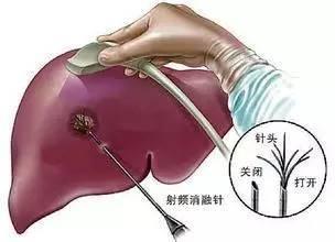 肝癌的最新治疗方法